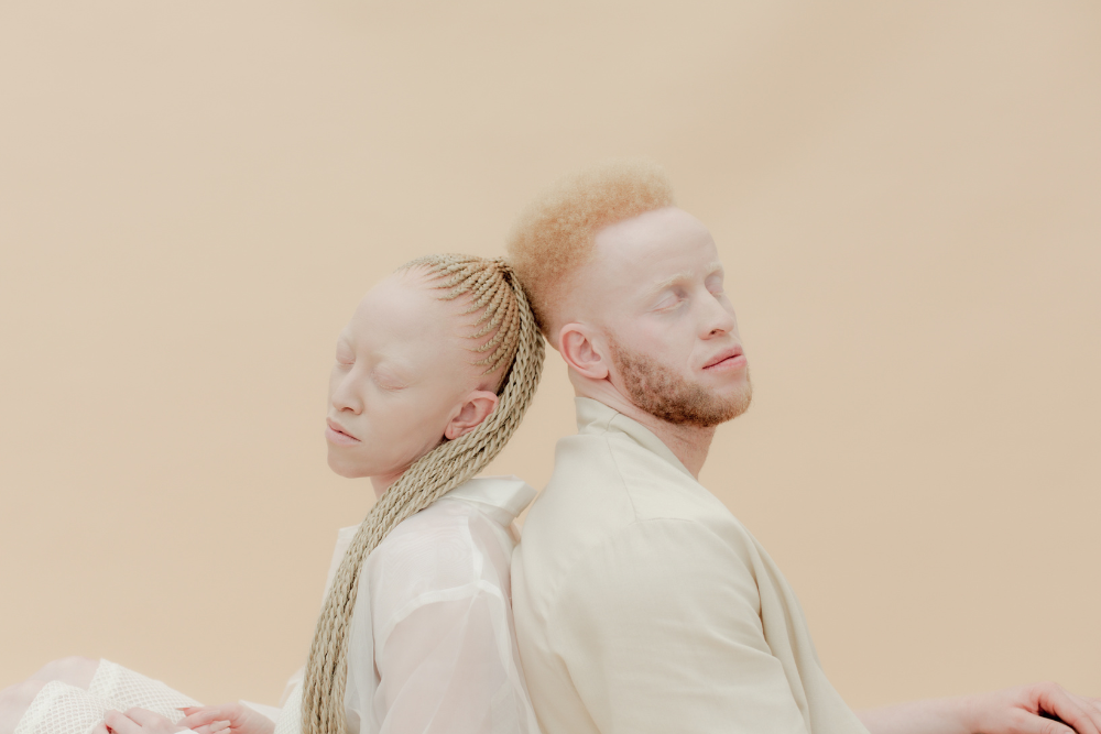 albinismo oculare